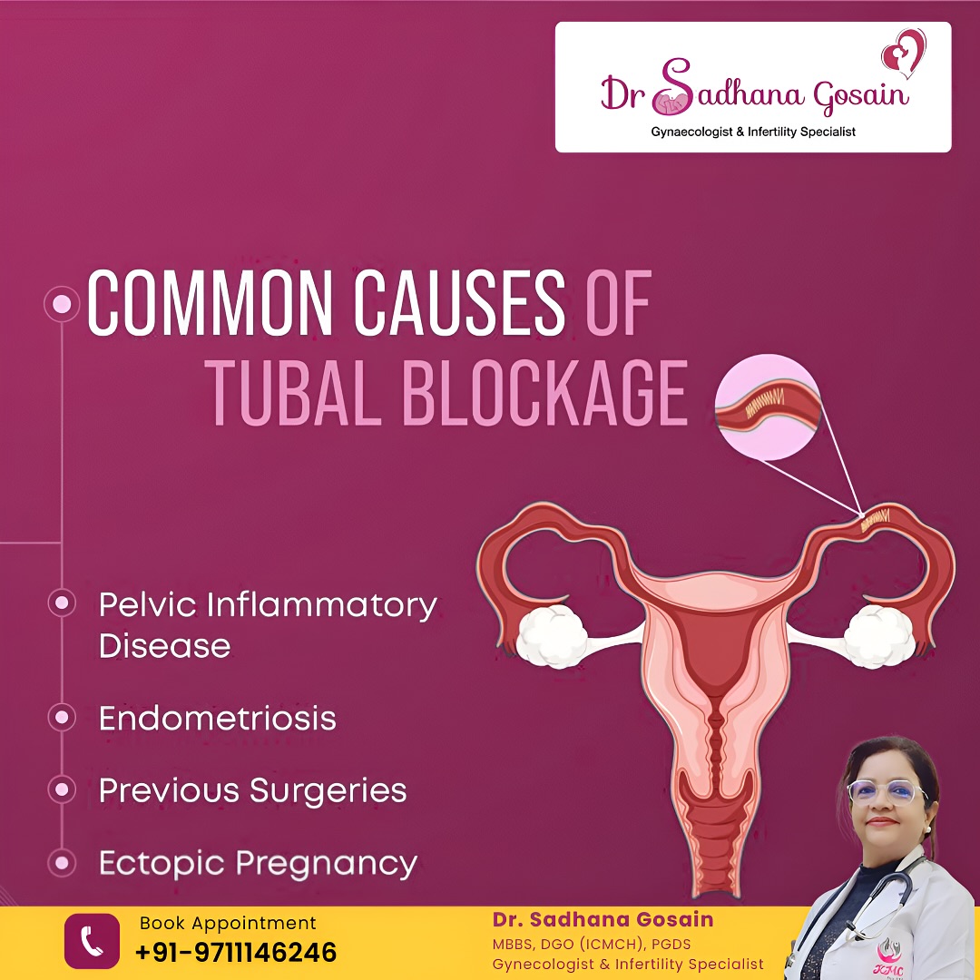 Common Causes of Tubal Blockage