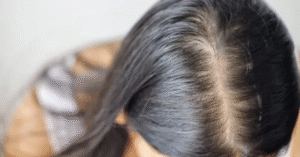 Hair Fall After Delivery