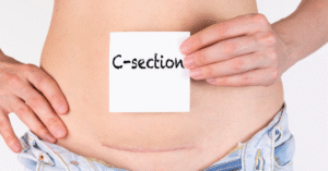 Ideal Time to Conceive after Caesarean Delivery