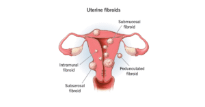Symptoms of Uterine Fibroids