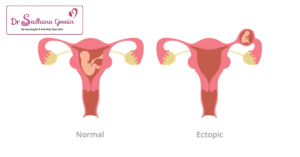 What is Ectopic Pregnancy
