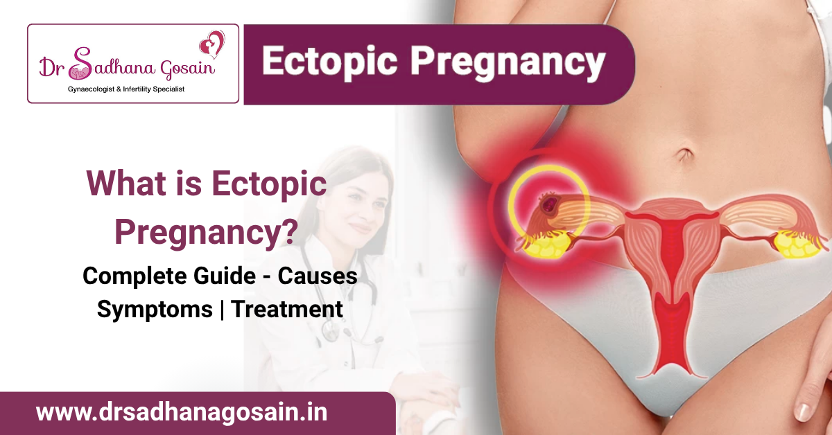 What is Ectopic Pregnancy – Complete Guide