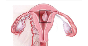 What is Uterine Polyp