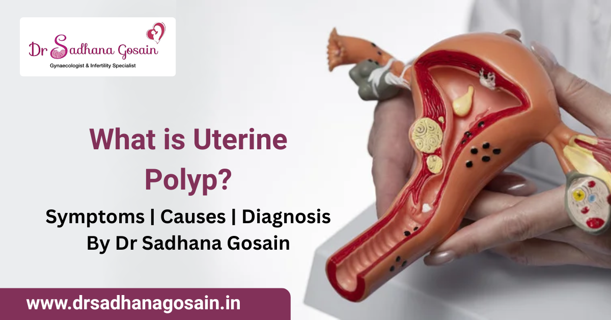 What is Uterine Polyp? Understanding Symptoms, Causes, and Diagnosis