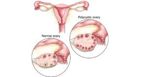 What is the Main Cause of PCOD